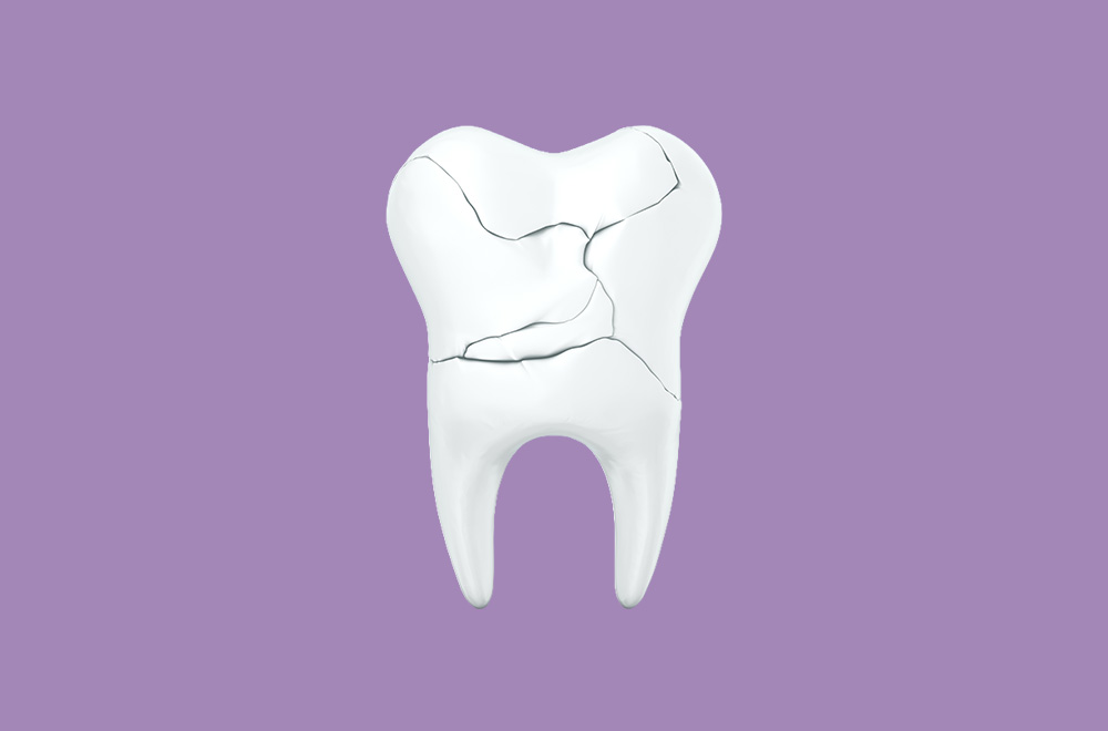 broken tooth